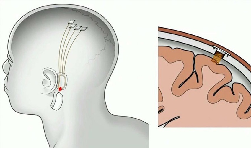 Neuralink