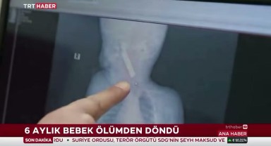 Karaman'da Kumanda Pili yutan 6 Aylık Bebeğin Hayatı Kurtarıldı