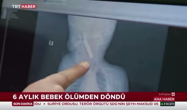 Karaman'da Kumanda Pili yutan 6 Aylık Bebeğin Hayatı Kurtarıldı